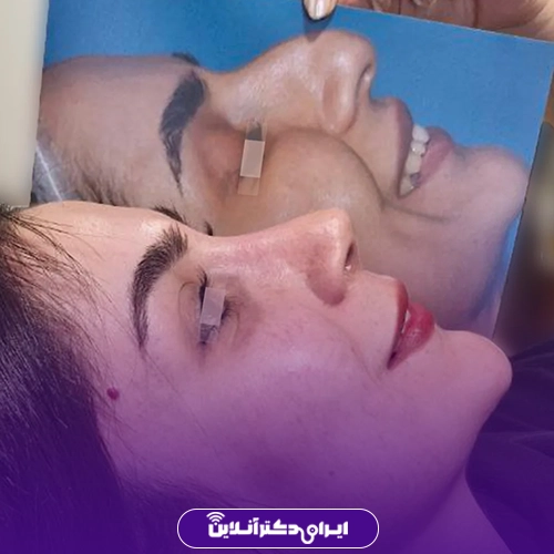 بهترین جراح بینی در کرج + نمونه کار و هزینه 1405 138 درمانهای موفق توسط دکتر سیما ندافی 4