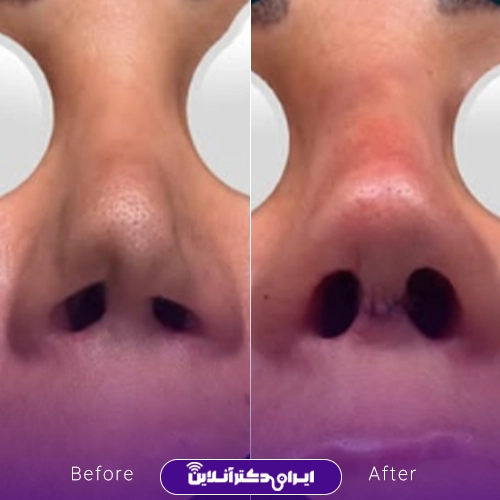 بهترین جراح بینی ترمیمی در تهران؛ معرفی 17 پزشک برتر 82 A sample of Dr. Akbar Etemadis before and after rhinoplasty surgery2
