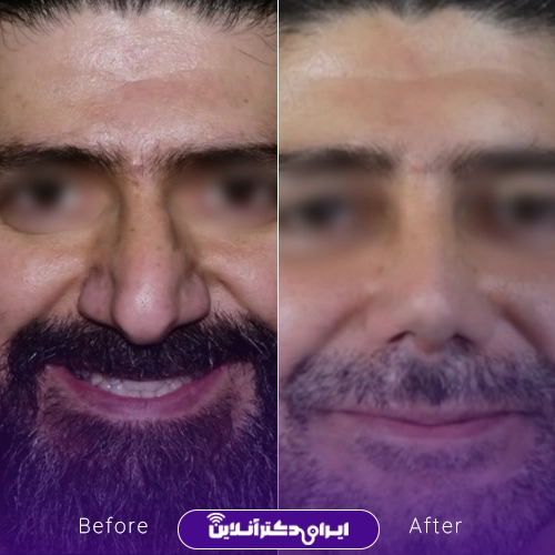 بهترین جراح بینی ترمیمی در تهران؛ معرفی 17 پزشک برتر 66 A sample of Dr. Hamidreza Rastis nose repair surgery work4