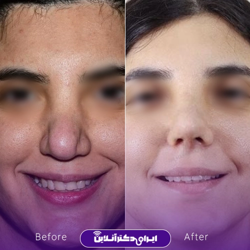 بهترین جراح بینی ترمیمی در تهران؛ معرفی 17 پزشک برتر 65 A sample of work before and after rhinoplasty surgery by Dr. Hamidreza Rasti3