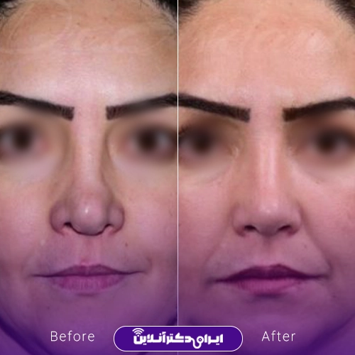 بهترین جراح بینی ترمیمی در تهران؛ معرفی 17 پزشک برتر 59 Before and after example of Dr. Ali Javadanis nose repair surgery2