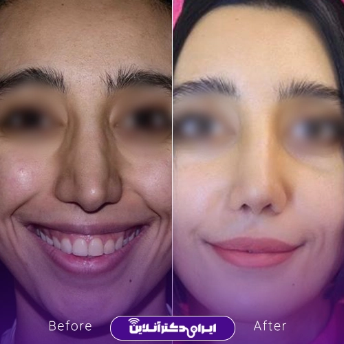 بهترین جراح بینی ترمیمی در تهران؛ معرفی 17 پزشک برتر 64 Before and after example of nose repair surgery by Dr. Hamidreza Rasti in Tehran2