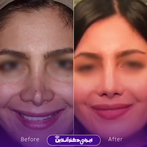 بهترین جراح بینی ترمیمی در تهران؛ معرفی 17 پزشک برتر 68 Before and after example of reconstructive rhinoplasty by Dr. Rozina Beshartizadeh1