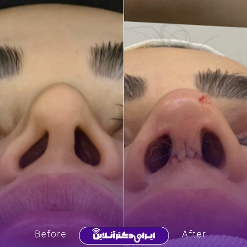 بهترین جراح بینی ترمیمی در تهران؛ معرفی 17 پزشک برتر 70 Before and after example of reconstructive rhinoplasty by Dr. Rozina Beshartizadeh3