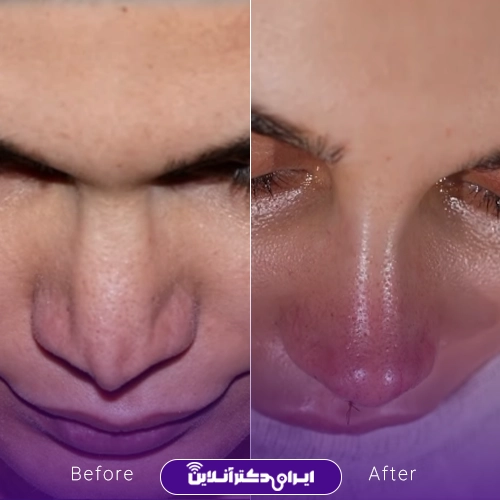 بهترین جراح بینی ترمیمی در تهران؛ معرفی 17 پزشک برتر 71 Before and after example of reconstructive rhinoplasty by Dr. Rozina Beshartizadeh4