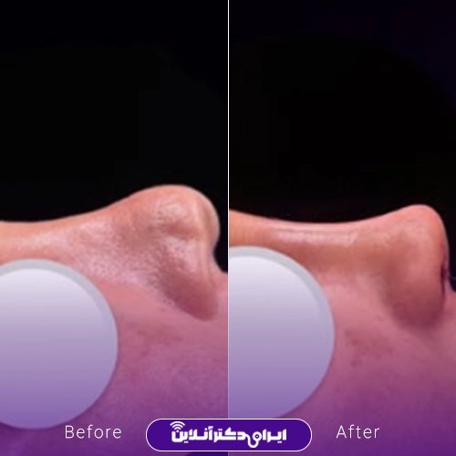 بهترین جراح بینی ترمیمی در تهران؛ معرفی 17 پزشک برتر 83 Before and after rhinoplasty surgery case study by Dr. Akbar Etemadi Tehran3