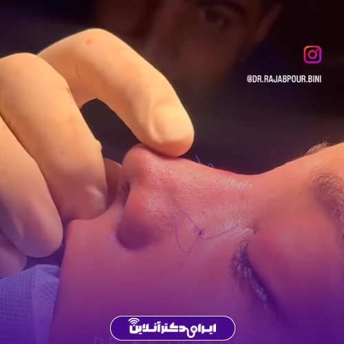 بهترین جراح بینی در تهران + لیست 18 مورد از بهترین جراحان 190 Dr. Ahmad Ali Rajabpours rhinoplasty case study4
