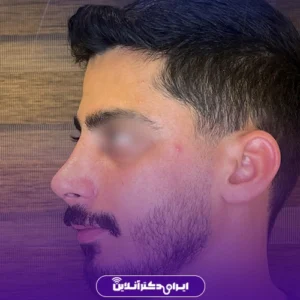 نمونه کار عمل بینی دکتر علی اصغر اسفندیار 1