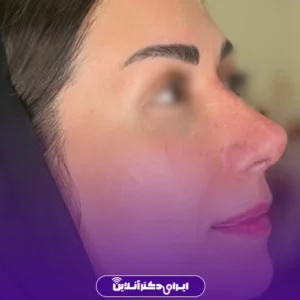 نمونه کار عمل بینی دکتر علی اصغر اسفندیار 10