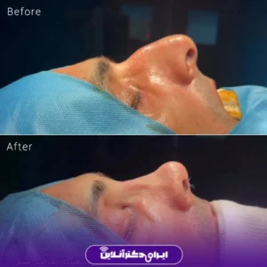 نمونه کار عمل بینی دکتر علی اصغر اسفندیار 2