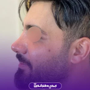 نمونه کار عمل بینی دکتر علی اصغر اسفندیار 3
