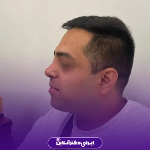 نمونه کار عمل بینی دکتر علی اصغر اسفندیار 4