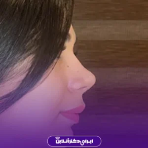 نمونه کار عمل بینی دکتر علی اصغر اسفندیار 6