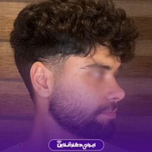 نمونه کار عمل بینی دکتر علی اصغر اسفندیار 7
