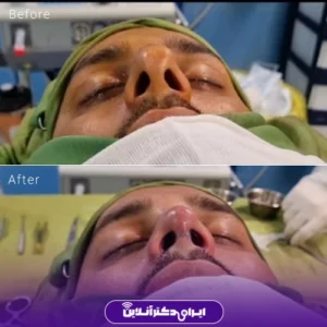 نمونه کار عمل بینی دکتر علی اصغر اسفندیار 8