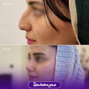 نمونه کار عمل بینی دکتر علی اصغر اسفندیار 9
