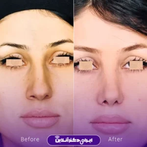 نمونه کار عمل بینی دکتر علی رحمانی 1