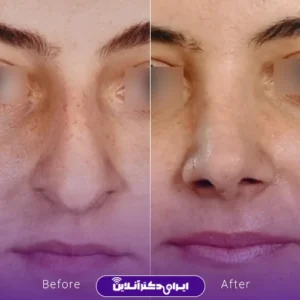 نمونه کار عمل بینی دکتر علی رحمانی 10