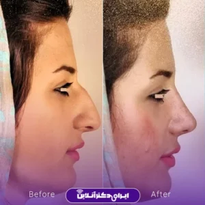 نمونه کار عمل بینی دکتر علی رحمانی 3