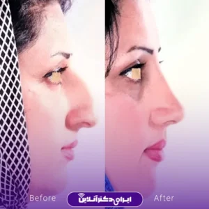 نمونه کار عمل بینی دکتر علی رحمانی 4