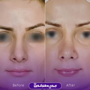 نمونه کار عمل بینی دکتر علی رحمانی 6
