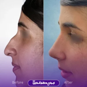 نمونه کار عمل بینی دکتر علی رحمانی 7