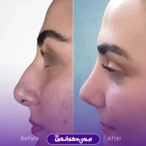 نمونه کار عمل بینی دکتر علی رحمانی 8