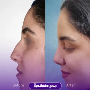 نمونه کار عمل بینی دکتر علی رحمانی 9