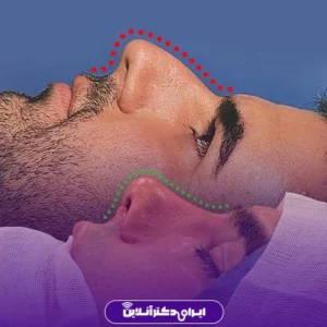 Dr. Azadeh Kazerouni's rhinoplasty case study 6