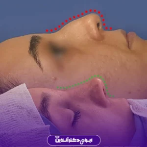 Dr. Azadeh Kazerouni's rhinoplasty case study 7