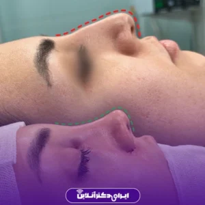 Dr. Azadeh Kazerouni's rhinoplasty case study 5