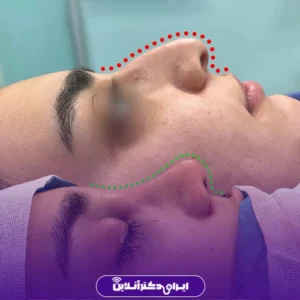 Dr. Azadeh Kazerouni's rhinoplasty case study 4