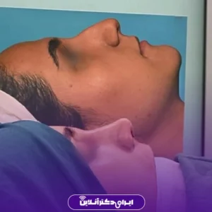 Dr. Azadeh Kazerouni's rhinoplasty case study 9