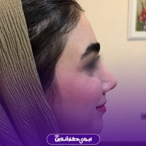 Dr. Azadeh Kazerouni's rhinoplasty case study 2