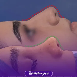 Dr. Azadeh Kazerouni's rhinoplasty case study 8