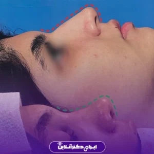 Dr. Azadeh Kazerouni's rhinoplasty case study 3