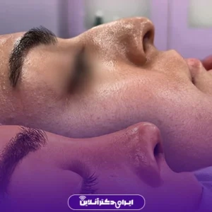 Dr. Azadeh Kazerouni's rhinoplasty case study 1