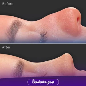 نمونه کار عمل بینی دکتر حامد هاتفی 2