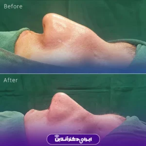نمونه کار عمل بینی دکتر حامد هاتفی 3