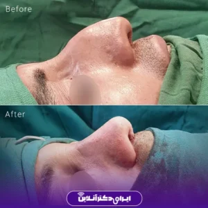 نمونه کار عمل بینی دکتر حامد هاتفی 7