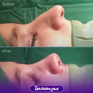 نمونه کار عمل بینی دکتر حامد هاتفی 8