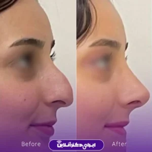 نمونه کار عمل بینی دکتر حمید مزارعی 10