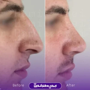 نمونه کار عمل بینی دکتر حمید مزارعی 9