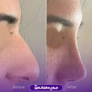 نمونه کار عمل بینی دکتر حمید مزارعی 1
