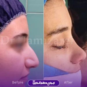 نمونه کار عمل بینی دکتر حمید مزارعی 2