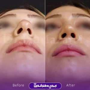 نمونه کار عمل بینی دکتر حمید مزارعی 3