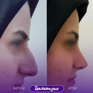 نمونه کار عمل بینی دکتر حمید مزارعی 4