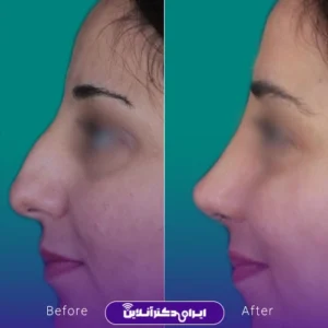 نمونه کار عمل بینی دکتر حمید مزارعی 5