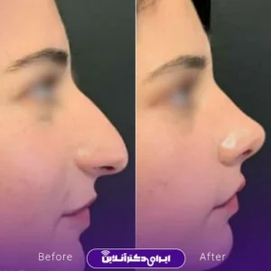 نمونه کار عمل بینی دکتر حمید مزارعی 6