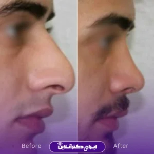 نمونه کار عمل بینی دکتر حمید مزارعی 7